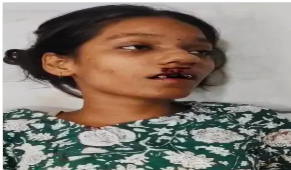 इंदिरानगर सावन महोत्सव में झूला टूटने से हादसा, तीन भाई-बहन समेत पांच घायल